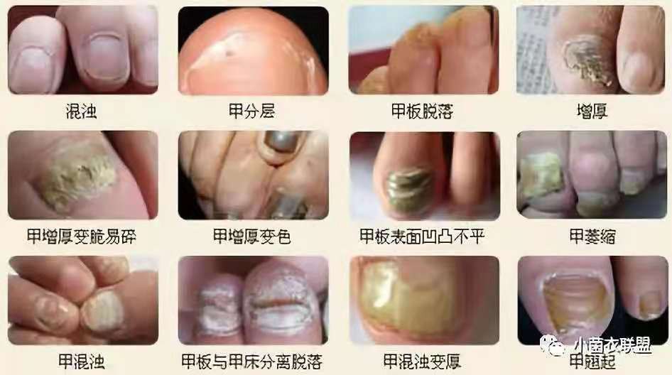 远离真菌,验方治愈一切真菌感染皮肤病