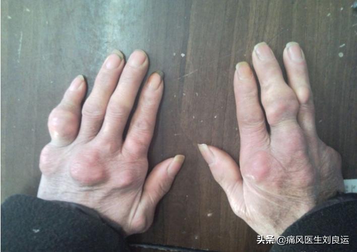 痛风吃什么中药有效治好,痛风吃什么药最快缓解