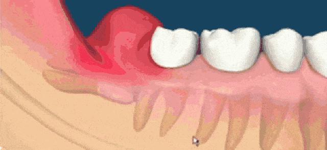 拔智齿根断在里面有什么危害,拔智齿牙根断在里面会怎么样