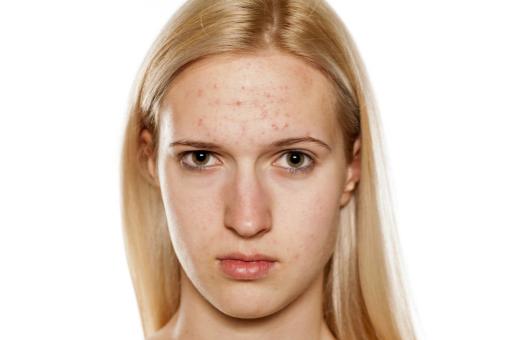 顽固痘痘怎么办教你一招正确祛痘,痘痘破了反复长不停如何正确祛痘