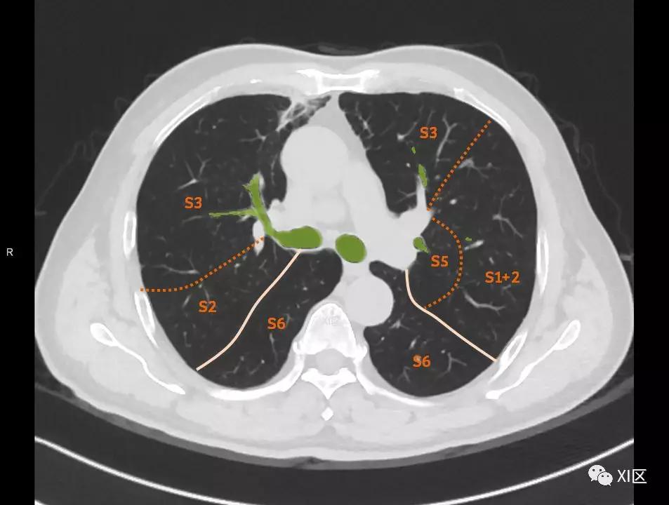 如此详细的肺部影像解剖，有点儿酷
