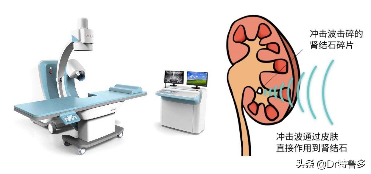 骨折了不长、长得慢怎么办？试试冲击波治疗吧