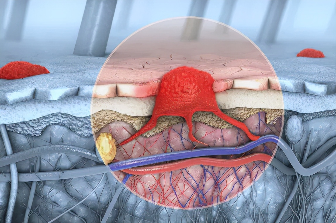 华大基因肿瘤治疗,华大基因检测肿瘤准确吗