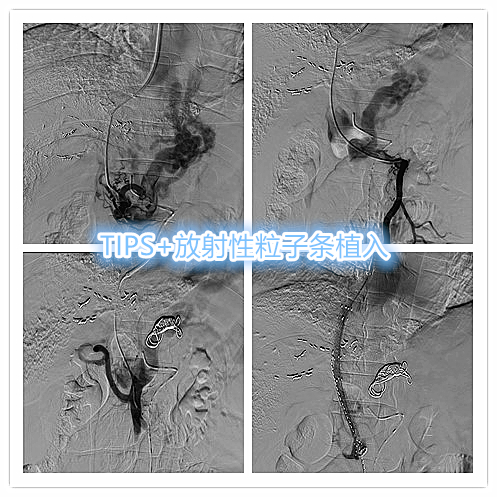 肝癌门静脉癌栓能做介入手术吗,肝癌门静脉癌栓中医治疗