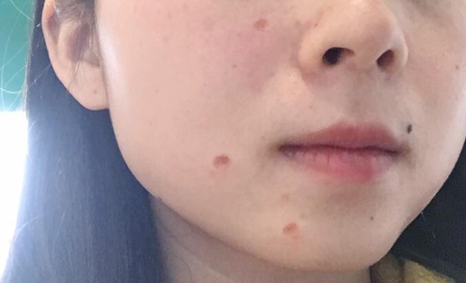 药水点痣和激光祛痣有什么区别,祛痣用激光还是药水效果好点