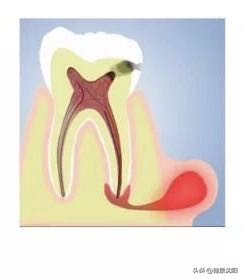 牙龈有脓包怎样引流,把牙龈里的脓水吃下去了怎么办