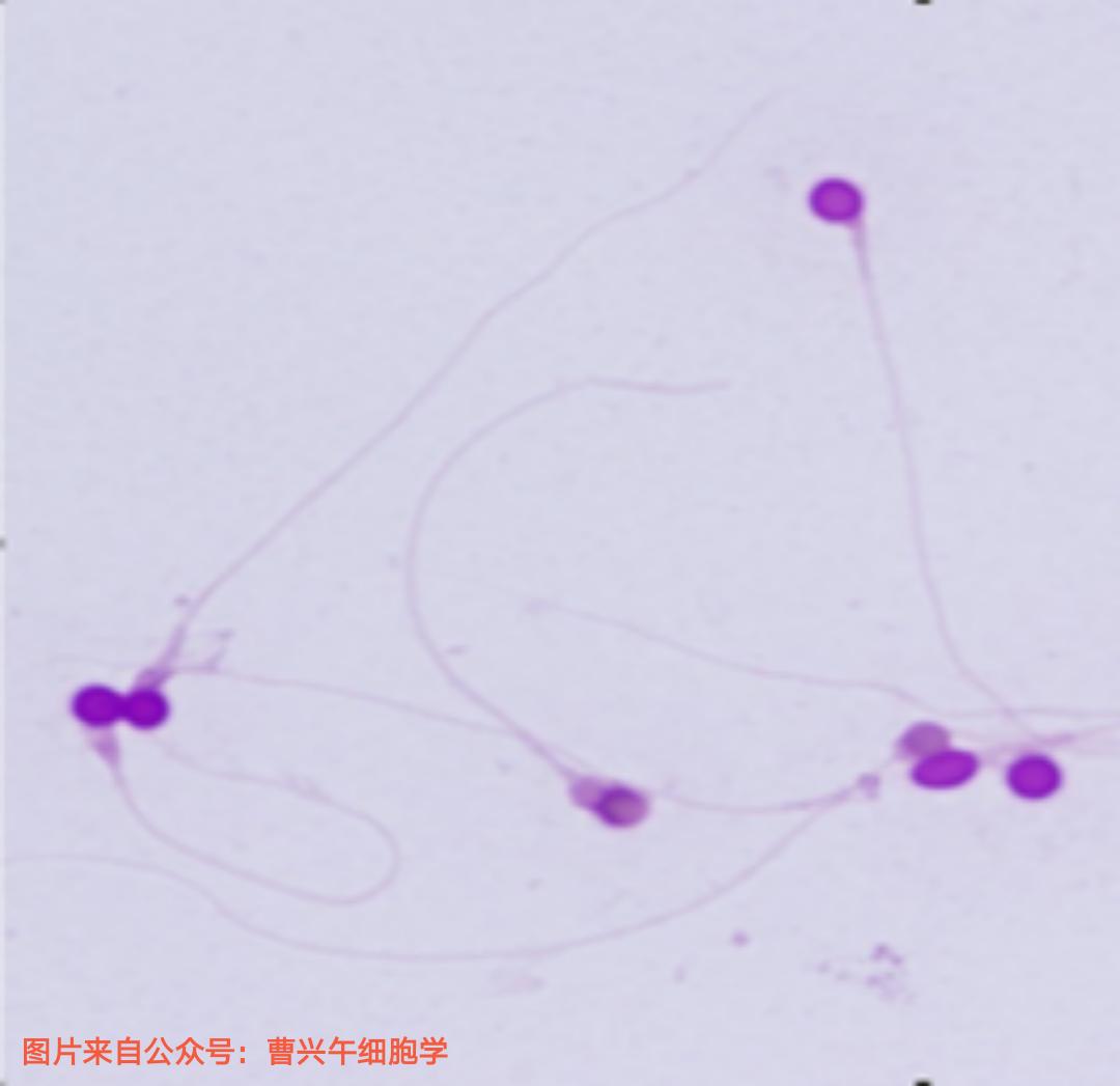 男科诊疗纪实,男科专家谈精子系列