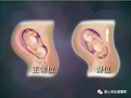 胎儿臀位最晚什么时候能转为头位,胎儿头位和横位有什么区别