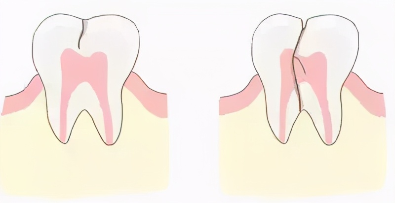没蛀牙但是牙痛牙龈肿,没蛀牙只是牙髓炎怎么治疗
