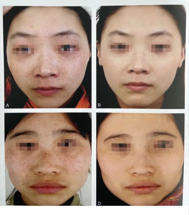 超皮秒避坑,超皮秒祛斑适合角质层薄的人