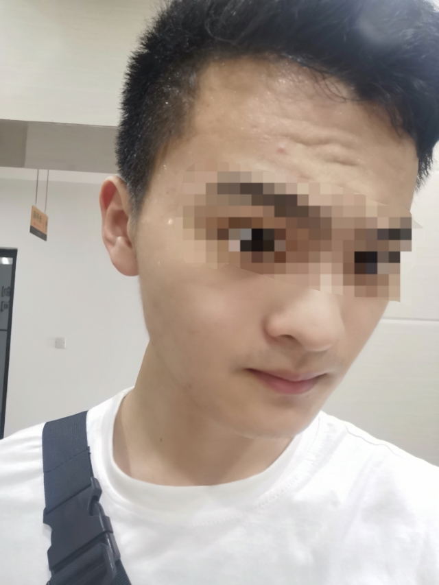 痘印是怎么出来的,痘印是怎么生成的