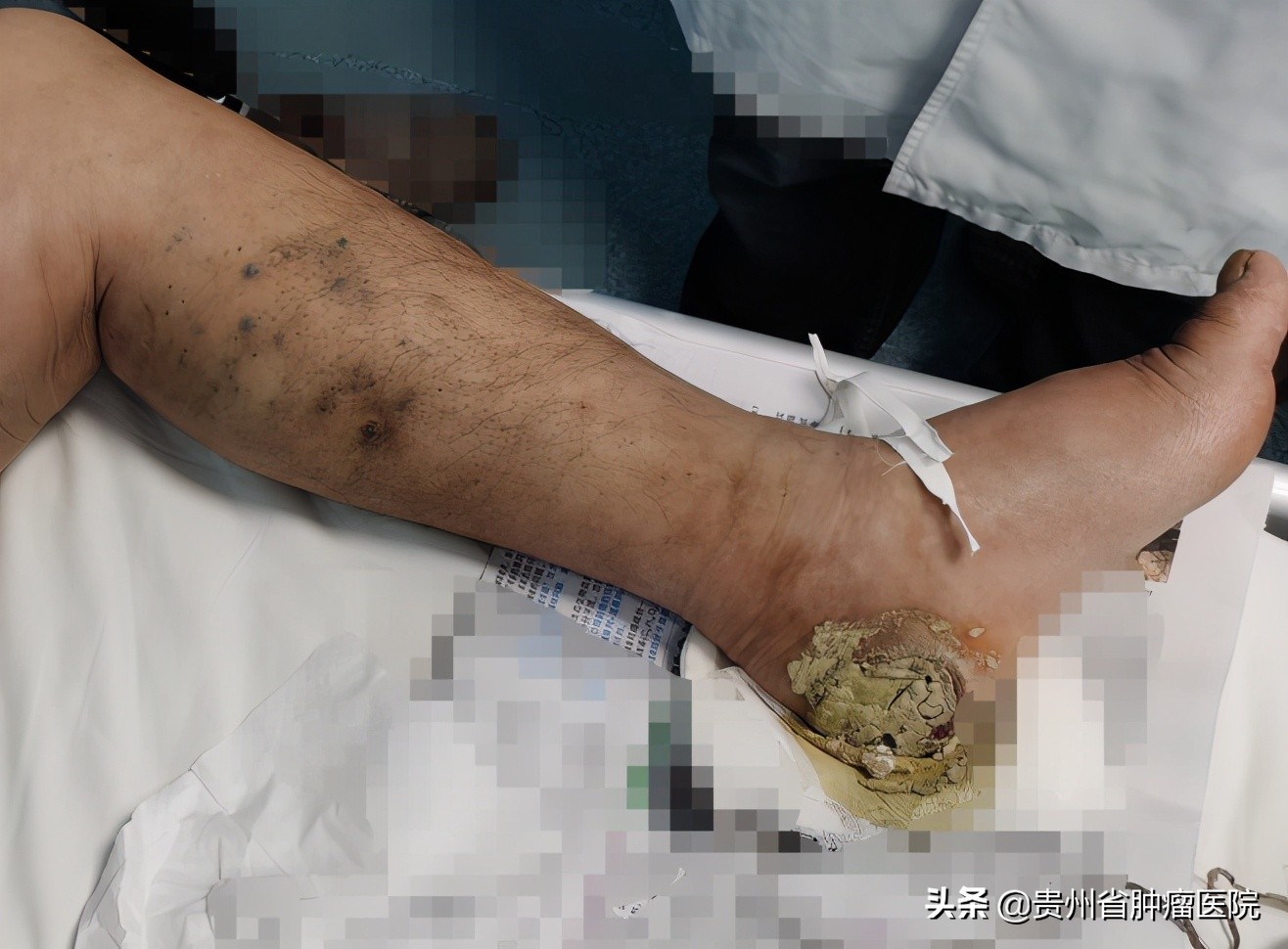 当心“魔鬼之眼”——黑色素瘤