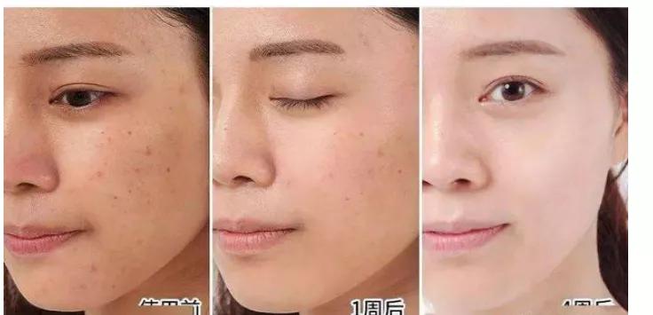 泽佳淡斑精华怎么样好用吗,泽佳淡斑精华好用吗怎么样