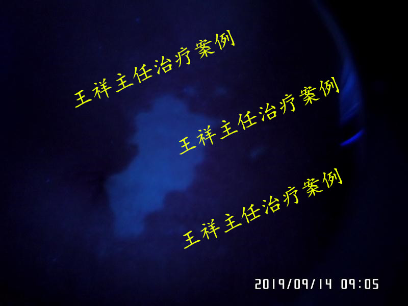 白癜风黑色素种植效果好吗,黑色素种植治疗白癜风费用