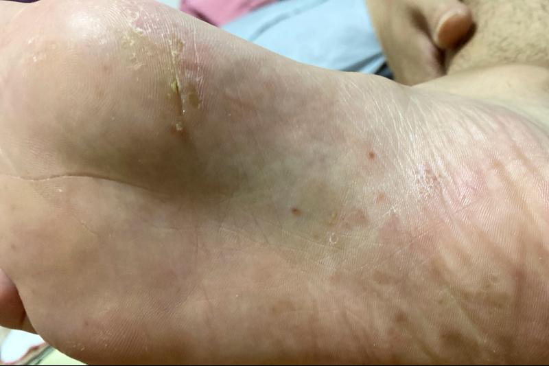 脚上干燥脱皮是真菌感染嘛,脚上因为真菌而开裂怎么办