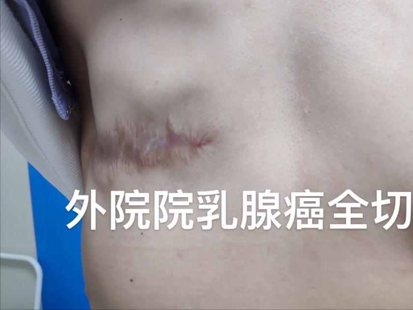 乳腺癌乳房重建用放疗吗,乳腺癌乳房重建术