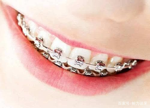 做牙齿矫正老了会不会容易掉牙,牙齿矫正以后年龄大了会先掉吗