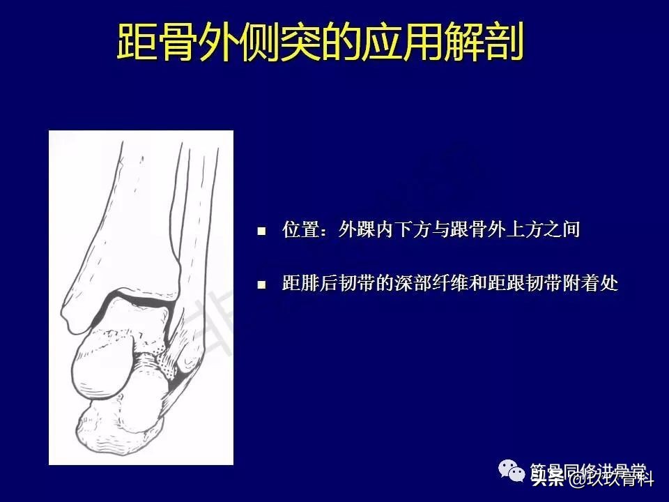 距骨骨折后遗症,距骨骨折怎么办