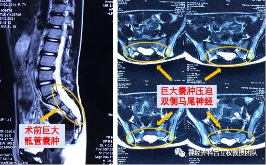 骶管囊肿的非手术治疗,骶管囊肿手术失败有什么后果