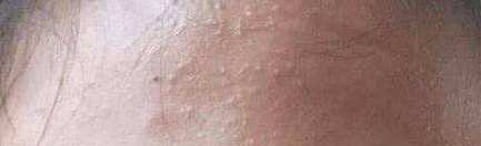 护肤解决痘痘和闭口,护肤毛孔粗大闭口怎么补救