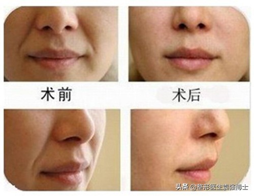 法令纹最新整形消除法,怎样医疗美容去除法令纹