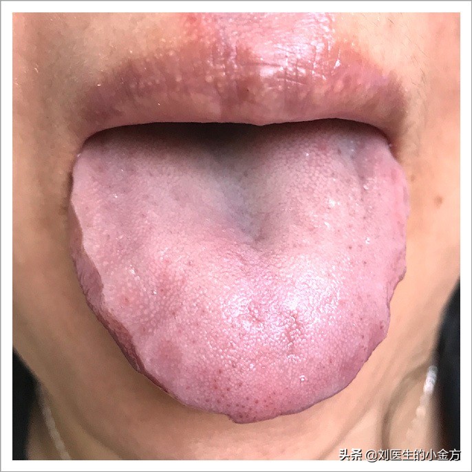 舌象图解大全中医舌诊,最全中医舌诊图谱来了
