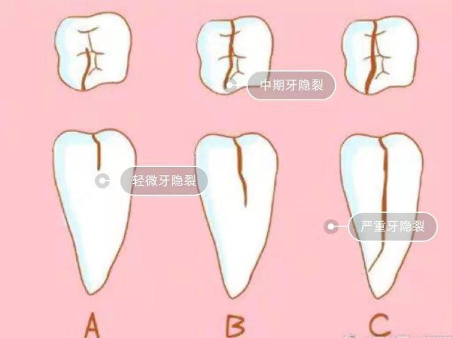 牙齿总是酸痛怎么解决,牙齿总是酸痛是什么原因造成的