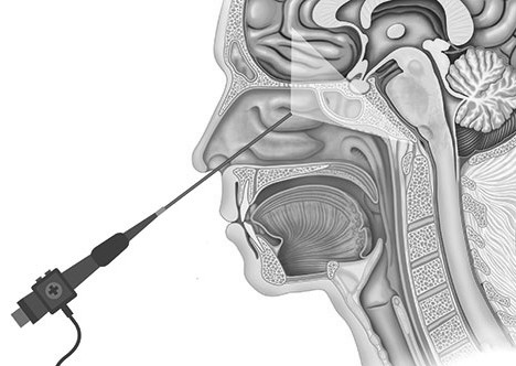 神经外科微创治疗手法演示,神经外科开颅微创手术