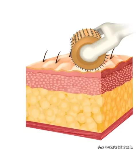 痘痘肌女孩必看,油痘肌必须知道的