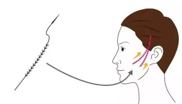 张宗学博士线雕案例分析,张宗学线雕案例