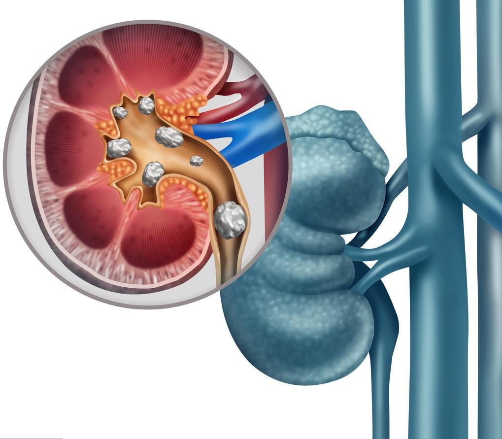 1厘米肾结石有事情吗,肾结石一个1.2一个1.6可以碎石吗