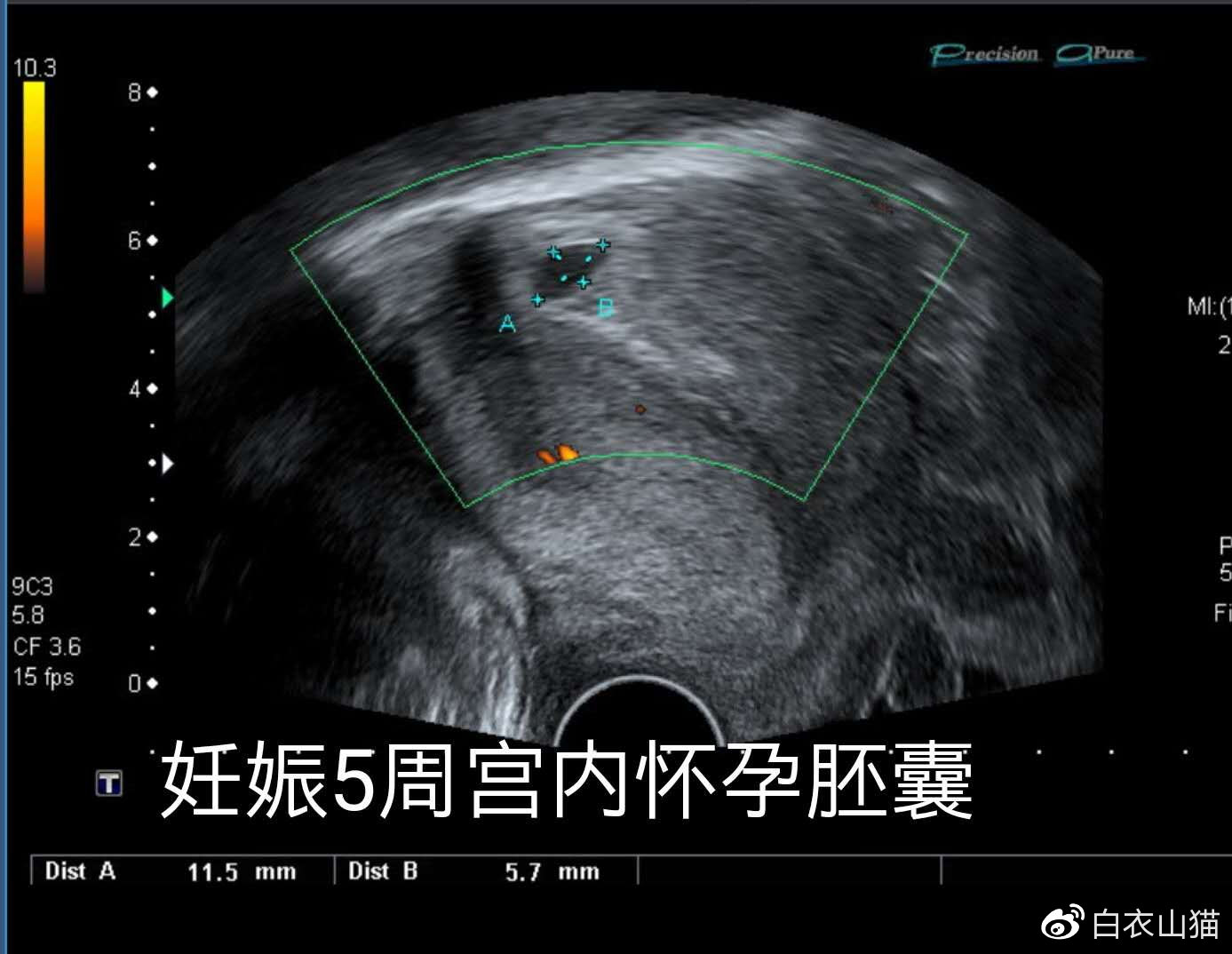 双胞胎，一个在宫内，一个躲宫外。孕妈生命垂危，医生妙手回春！