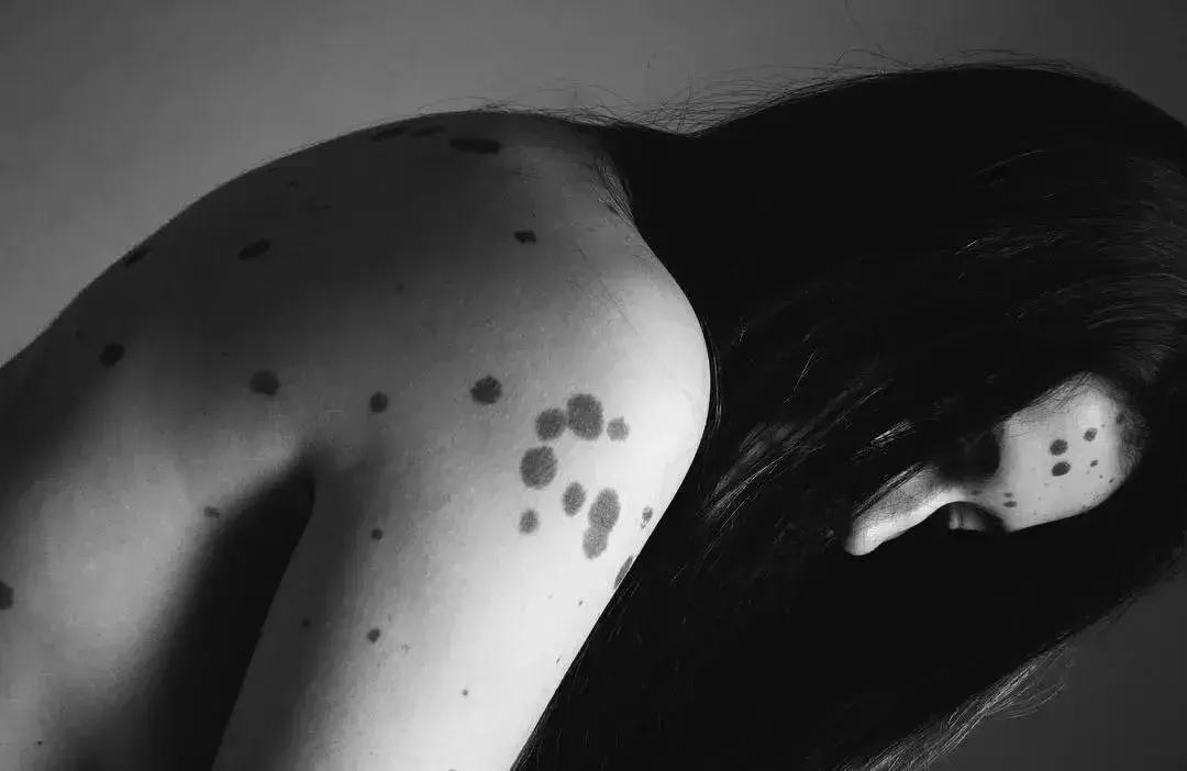 全身黑斑被骂“斑点狗”，身高160的她却成为最美超模…