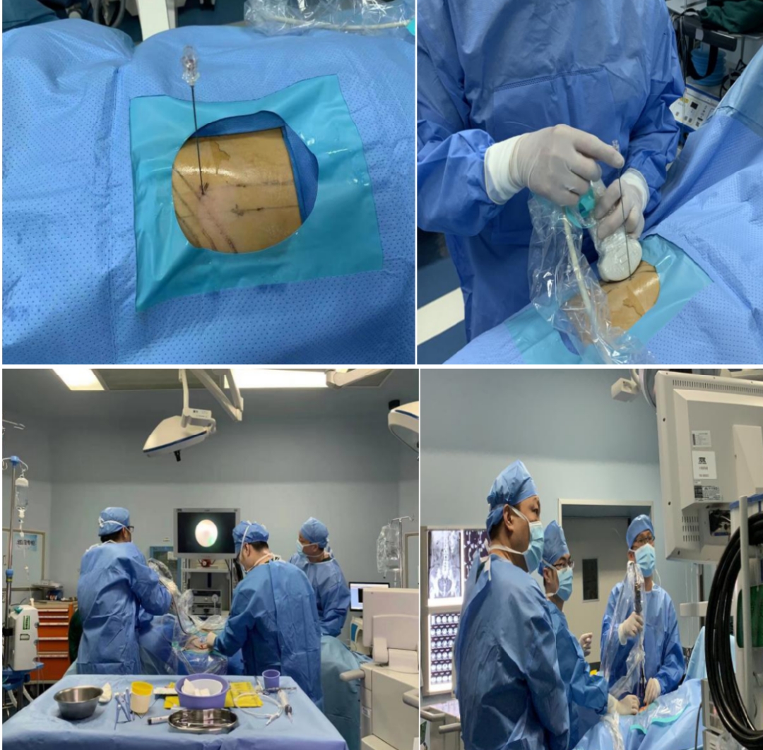 腰痛结石有哪些症状,腰痛结石