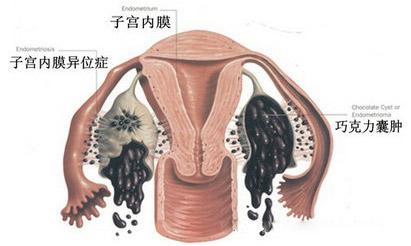 什么样的人容易复发巧克力囊肿,巧克力囊肿打三针能控制不复发吗