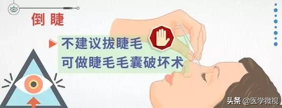 睫毛长倒睫怎么办,睫毛倒长扎眼睛怎么处理