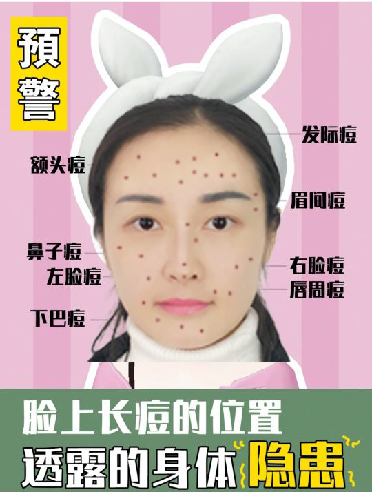 脸上各个位置长痘痘的原因是什么,脸上痘痘的种类及图片