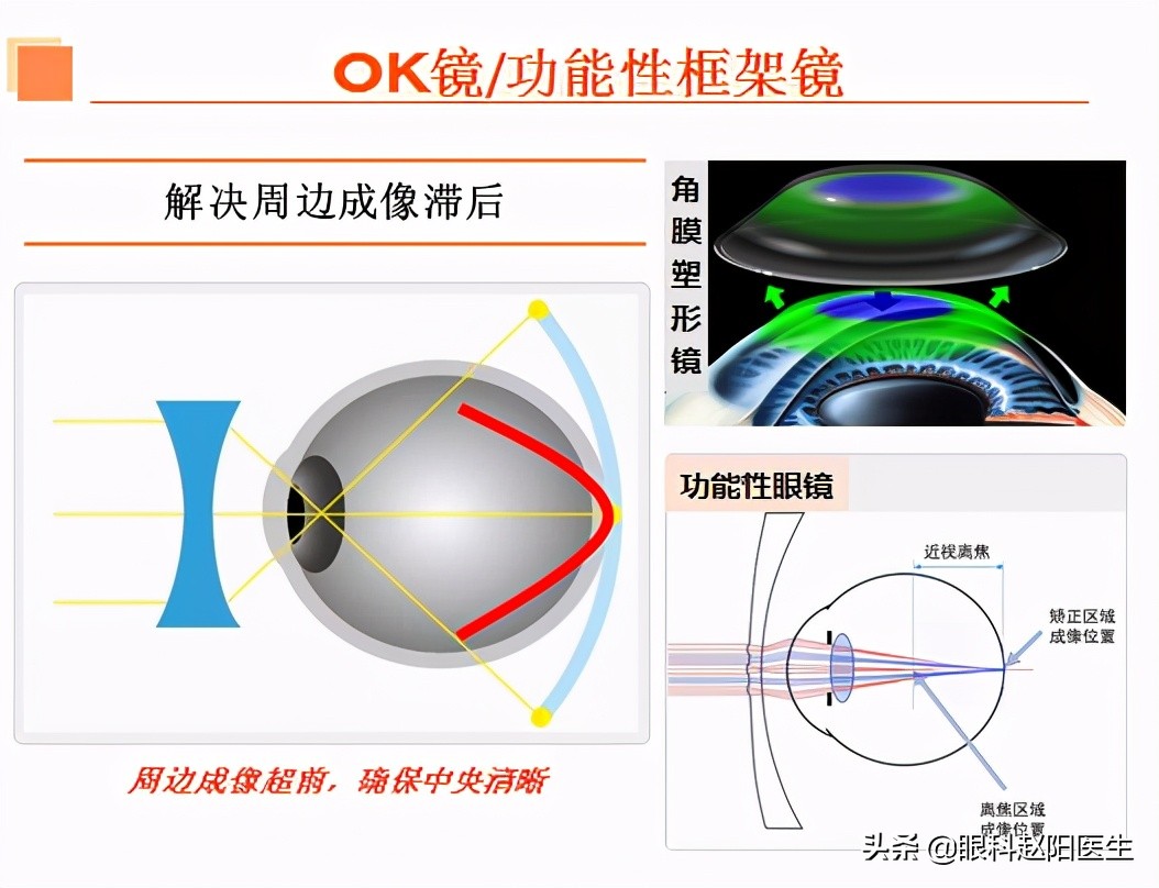 近视眼轴缩短什么原因,缩短眼间距的方法