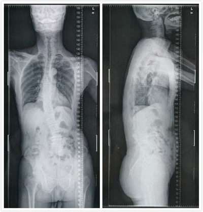 腰椎侧凸治疗方法,腰椎右侧凸最好的恢复方法