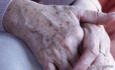 消除老年斑的十大良方,中医怎样调理手背上的老年斑