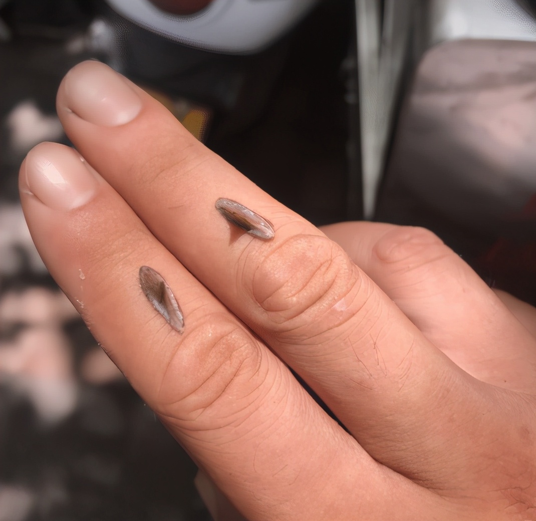 手上长了个手刺怎么办,手上长了一根肉刺很疼