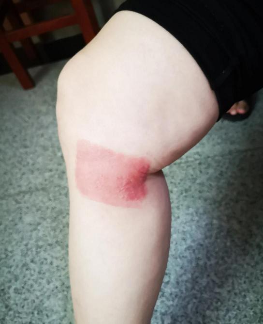 腿疼膝盖骨刺的最快解决方法,膝盖骨刺关节炎疼痛解决最好办法