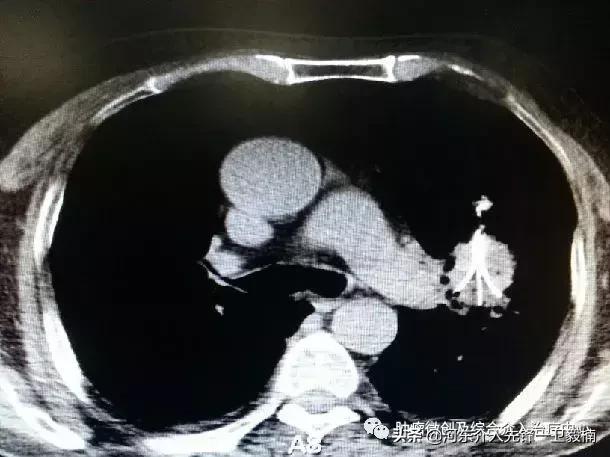 肺癌诊断与微创综合治疗,肺癌晚期的微创介入治疗