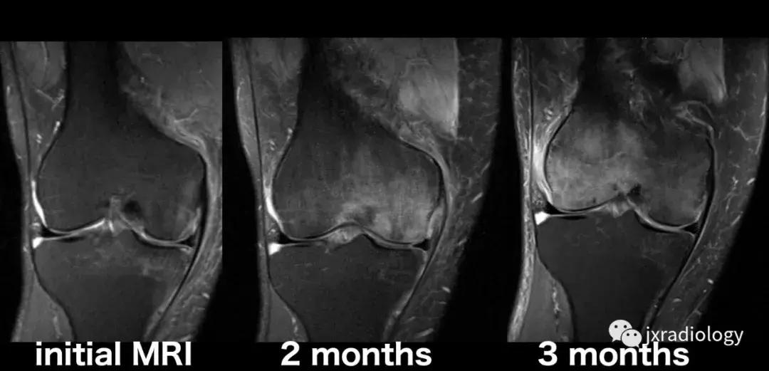 磁共振天天诊断骨髓水肿，但您知道原因吗？