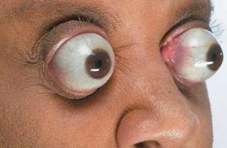 告别金鱼眼的实用简单方法,肿泡眼金鱼眼怎么改善