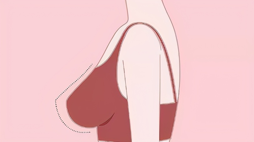 假体隆胸怎么选择合适的假体,隆胸假体怎么样