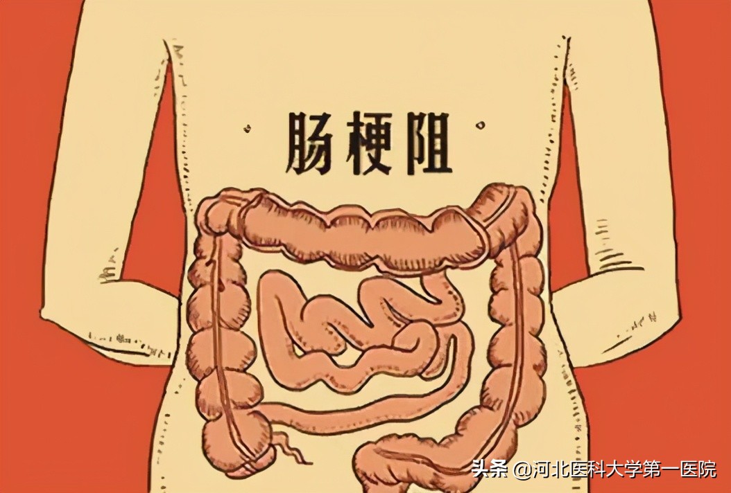 手术切掉4米小肠,两次结肠癌手术切掉共50公分肠子