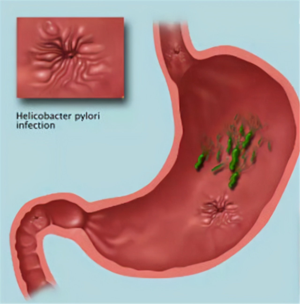 萎缩性胃炎是脾胃虚寒引起的吗,萎缩性胃炎算是严重的胃病吗