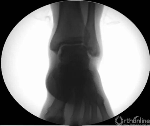 骨折闭合复位髓内钉内固定术,骨折闭合复位