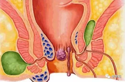 肛周脓肿12345678